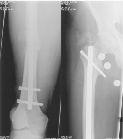 X-ray showing femoral nail and anchor screws