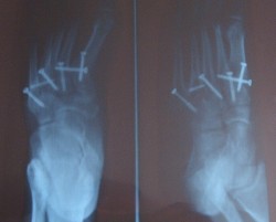 X-rays showing positioning of screws