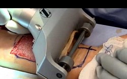 Skin removal instrument In action