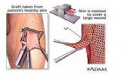 Schematic showing the complete procedure