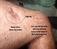 Repairs to my right thigh