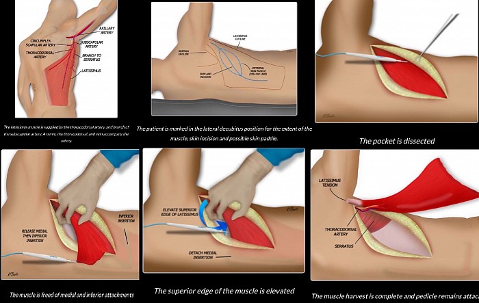 Photo showing Muscle removal sequence