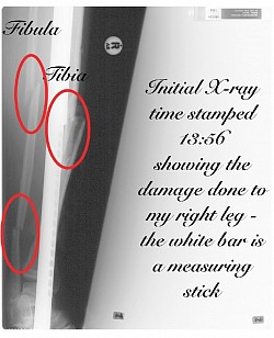 Compound fracture r lower leg