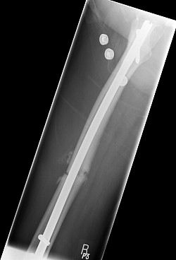 As the Tibia did not repair itself a Nail was inserted in March 2005