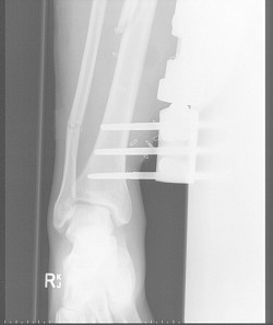 Damage to both bones